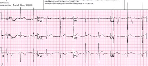 Dr. Smith's ECG Blog: Does this ECG represent acute ischemia?