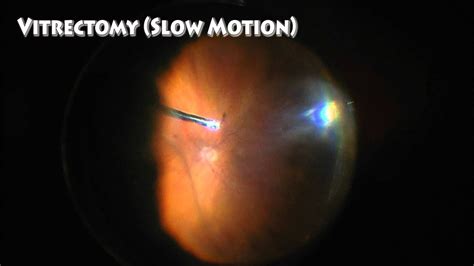 Vitrectomy For Vitreous Opacities Floater Only Vitrectomy High