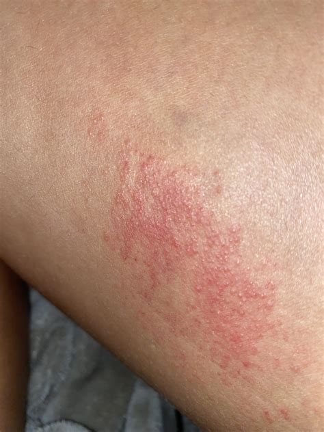 Rash What Is This Caused By Itchy Red Raised Bumps Upper Left Thigh R Dermatologyquestions