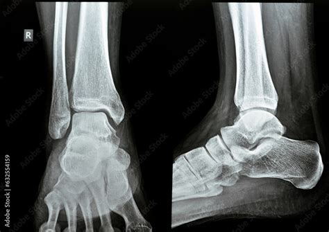 Plain X Ray Ap Lateral Views Of The Right Ankle Showing Syndesmotic