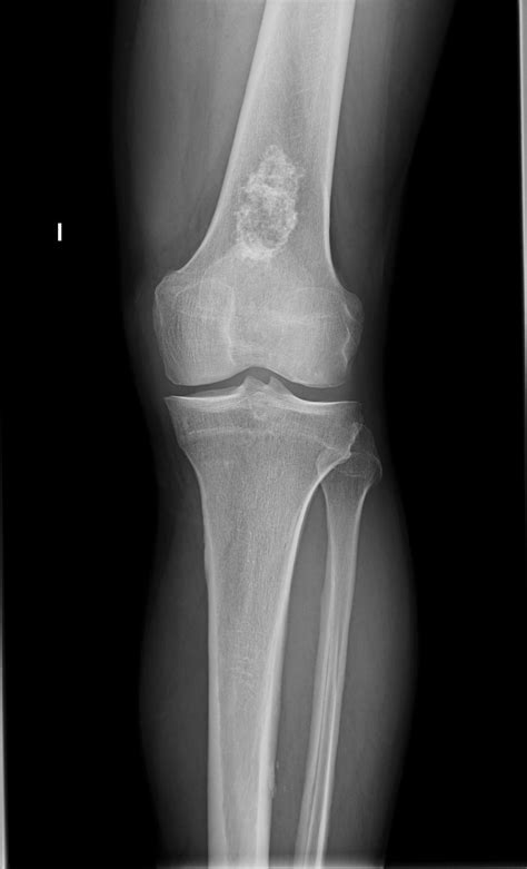 Chondroma In An Elderly Patient