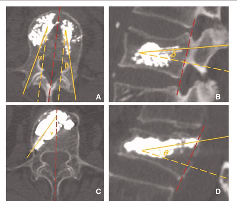 Figure 5 From A Modified Trajectory Of Kyphoplasty Via Superior Pedicle Notch For Osteoporotic