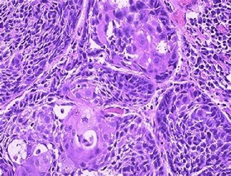 Well Moderately Differentiated Squamous Cell Carcinoma Download