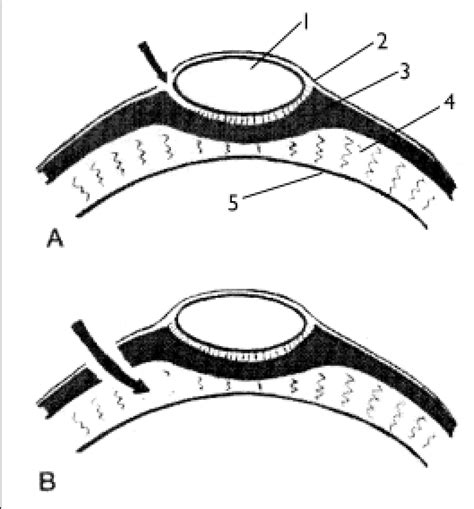 cross sectional schema   extensor apparatus   level