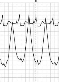 Pulmonary Artery Pressure Monitoring - Clinical Tree