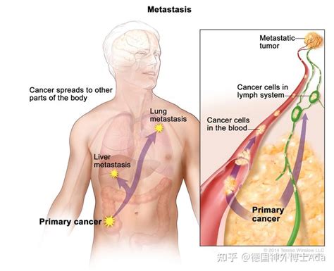 《nature》：首张“癌症转移图谱”问世！揭秘人体癌细胞转移规律，癌细胞最容易转移至哪些部位？ 知乎