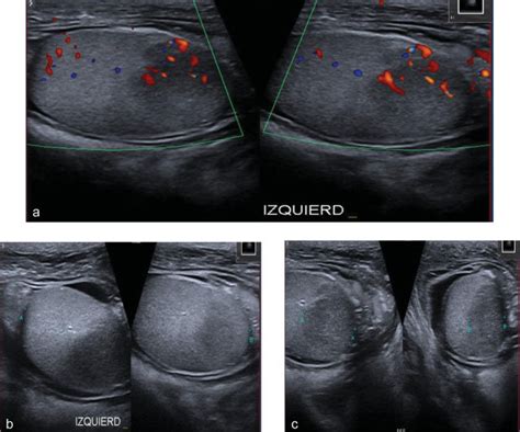 a c Ecografía doppler testicular Testículo izquierdo con dos