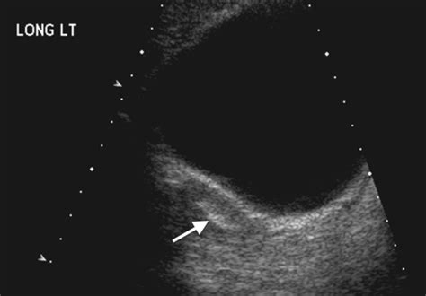 Mullerian Agenesis - Causes, Symptoms, Treatment and Pictures