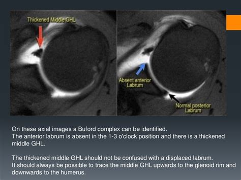 Shoulder Labral Tears Mri