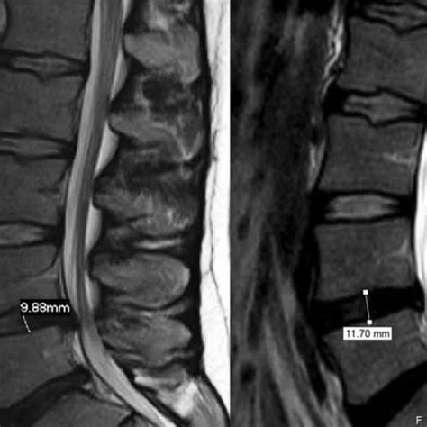 Sagittal T 2 Weighted Magnetic Resonance Imaging Of The Lumbar Spine