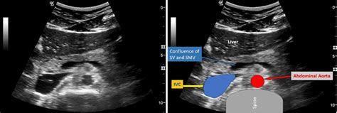 Inferior Vena Cava Ivc Assessment For Volume Status In Point Of Care