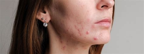 8 Sensitive Skin Acne Treatment Considerations