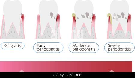 Illustration By Stage Of Periodontal Disease Order Of Progress