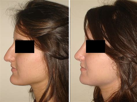 Rhinoplastie Tunisie la chirurgie du nez pas chère