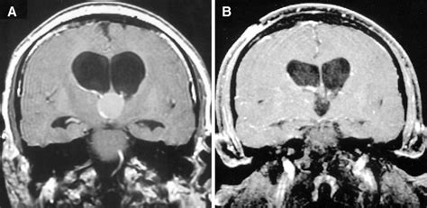 Mri Scans In A 43 Year Old Man With A Third Ventricle Colloid Cyst A