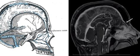 Foramen Cecum Vein | neuroangio.org