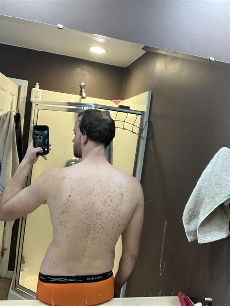 Skyrizi Progress - 2 Months and 2 Injections later. Had strep in