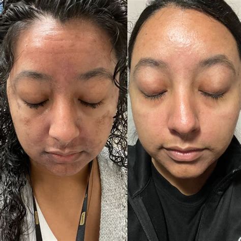 Jessner Peel Before And After Jessner Peel Facial Treatment Peel