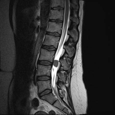 Spinal Meningioma L3 4 Radiology Case Radiopaedia Org