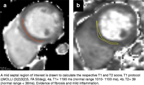 A B Myocardial T1 And T2 Mapping Download Scientific Diagram