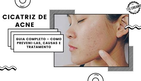 Guia Completo Cicatriz De Acne Como Preveni Las Causas E Tratamento