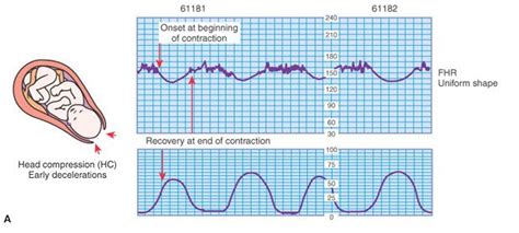 Early Decelerations Occur During Contractions As The Fetal Head Is Pressed Against The Woman S