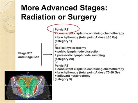 Radiation For Cervix Cancer