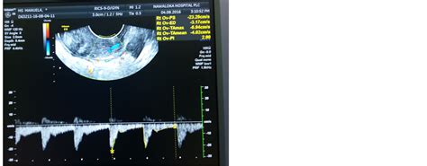 Transvaginal Color Doppler In The Assessment Of Cervical Carcinoma And