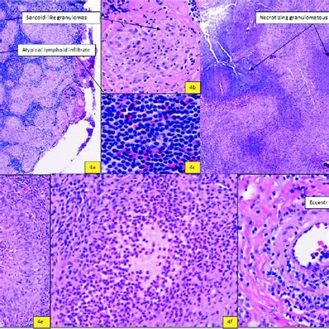 Differential Diagnosis Of Necrotizing And Non Necrotizing Granuloma