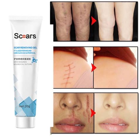 Scar Remover For Old Scar On Leg Effective Scar Repairing Gel Light