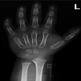 USG image of atrophic thyroid tissue due to thyroiditıs in the thyroid ...