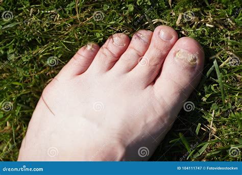 Onychomycosis Infection Fongique Des Clous Des Pieds Image Stock