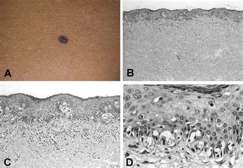 Correlation Between Clinical Atypia And Histologic Dysplasia In