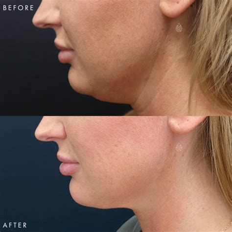 Las Vegas Chin Coolsculpting Treatment Sculpt Spa