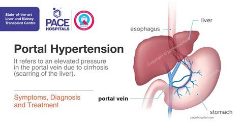 portal hypertension symptoms diagnosis  treatment