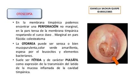 Guillermo Fonseca Otitis Media Cronica Serosa
