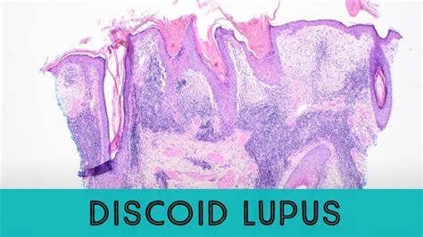 Discoid Lupus Erythematosus Under The Microscope Pathology Dermatology