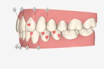 Invisalign Lite Cu Nto Cuesta Ferrus Bratos