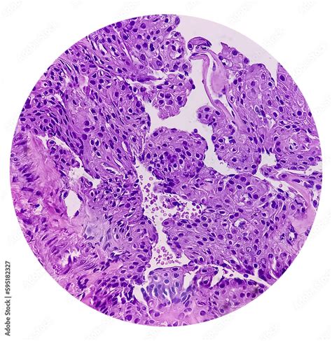 Foto De Nodular Cystic Hidradenoma Clear Cell Hidradenoma Nodular