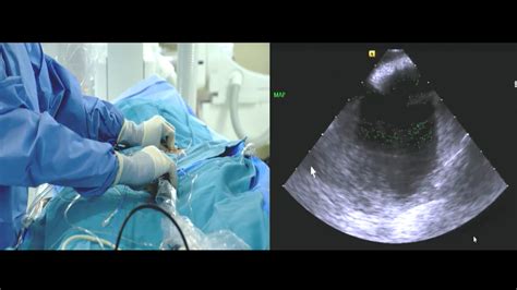 Intracardiac Echocardiography Views For Transseptal Puncture Johnson