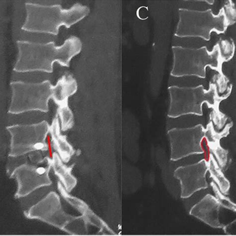 CT Related Index Measurement A B The L4 5 FH Measured On Preoperative