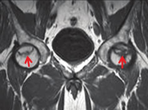 Cystic Lesion Femoral Head