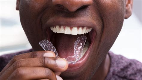 5 Invisalign Alternatives: Reviews And Costs (2025) – Forbes Health