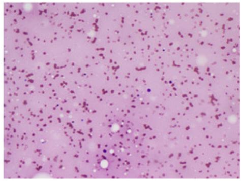 Figure From Serous Atrophy Of Bone Marrow A Rare Cause Of