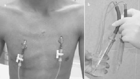 A Small Bore Catheter Drainage Of Bilateral Spontaneous Pneumothorax