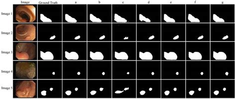 Lightweight Colon Polyp Segmentation Algorithm Based On Improved Deeplabv3