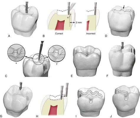 17 Class Ii Cast Metal Restorations Pocket Dentistry