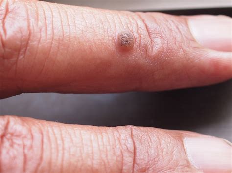 Black Warts On Hands