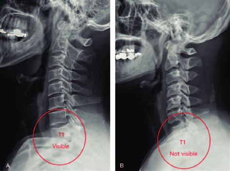 (A) T1 slope visible on the cervical spine lateral radiograph. (B) T1 ...