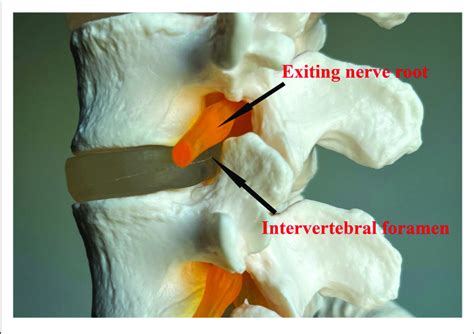 Anatomical Location Of The Exiting Nerve Root Intervertebral Foramen